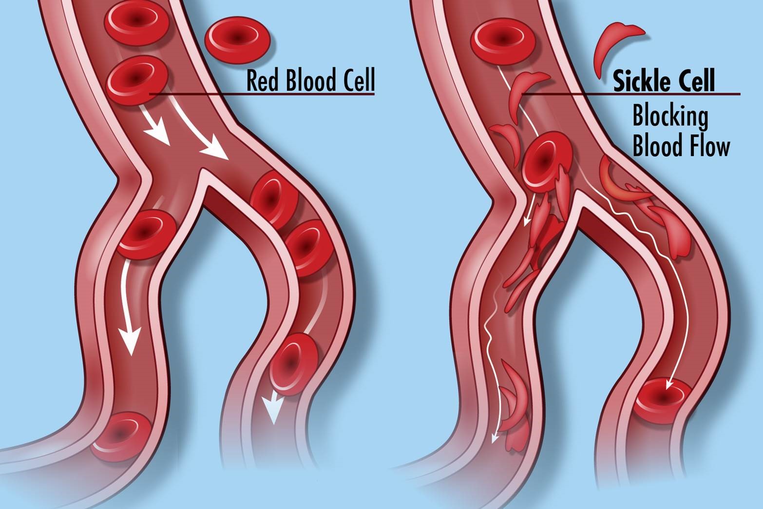 Two blood vessels, in tones of red, on blue background ... one shows normal red blood cells, the other shows sickle cells blocking the blood flow